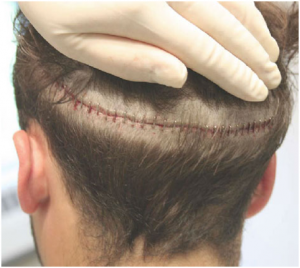 FUT hair transplant