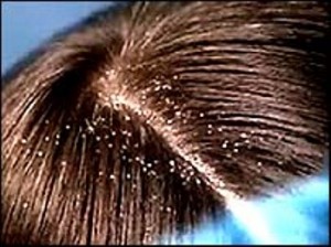 dandruff hair care