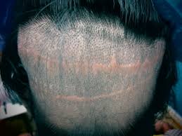 fue-harvesting