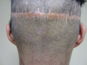 fut-hair-method