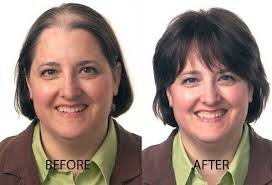 Hair surgery