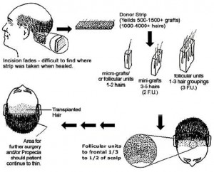 hair-transplantation-diagram