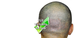 Fue-hair-transplant-in-Pakistan
