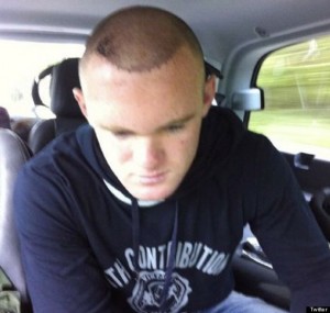 hair transplant cost wayne rooney